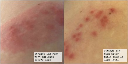 leg rash before and three days into GAPS